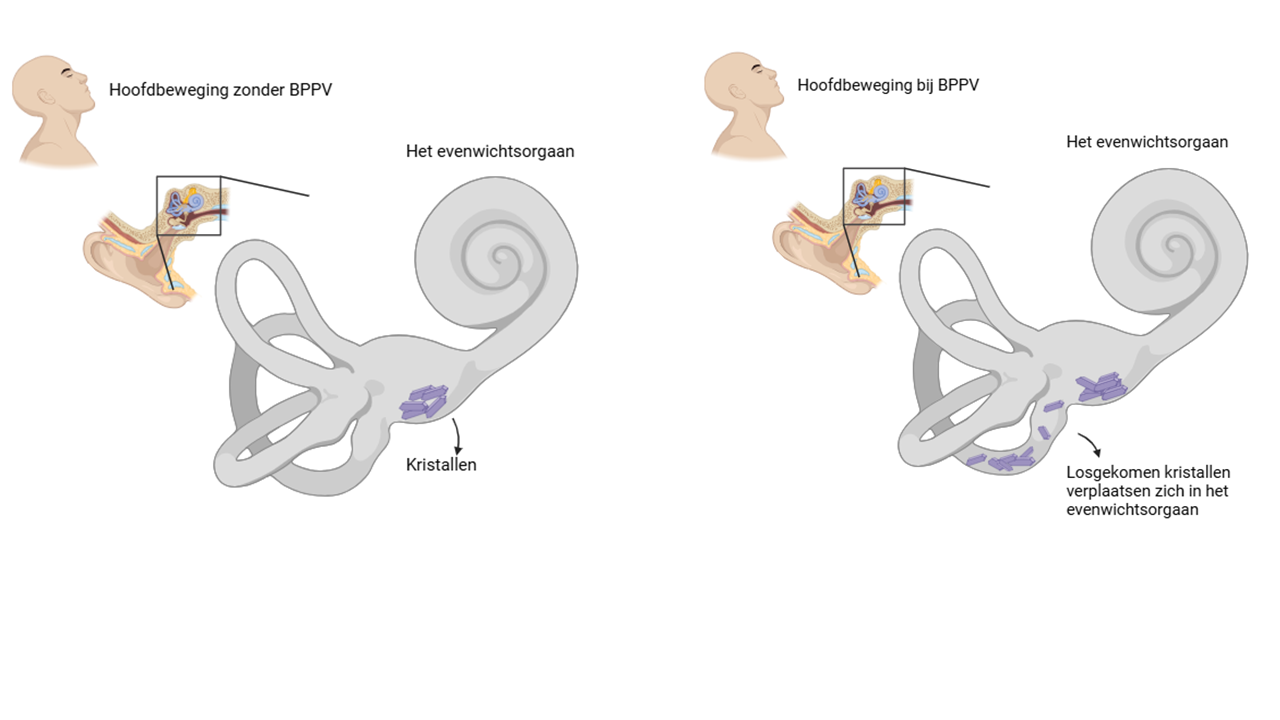 BPPV Kristallen In Evenwichtsorgaan